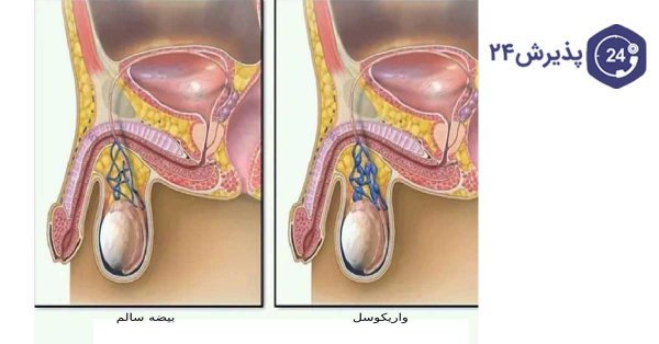  علت داخل رفتن کلاهک تناسلی مردان
