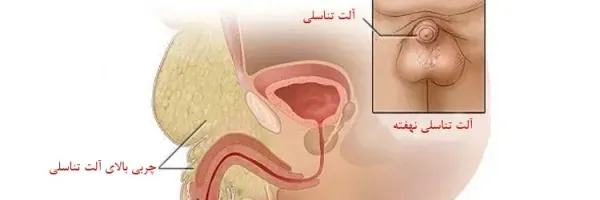  علت داخل رفتن کلاهک تناسلی مردان