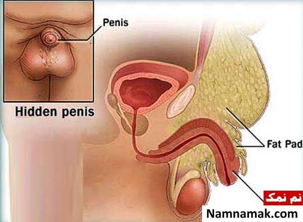  علت داخل رفتن کلاهک تناسلی مردان