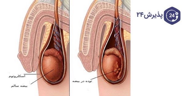  کدام بیضه اسپرم ساز است؟