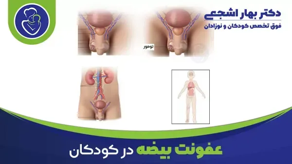  چه قرصی برای عفونت بیضه خوب است/ درمان اپیدیدیمیت
