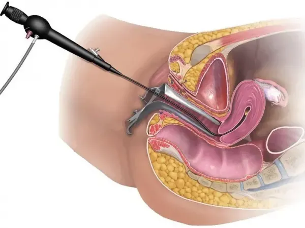  لاپاراسکوپی رحم بیهوشی دارد؟