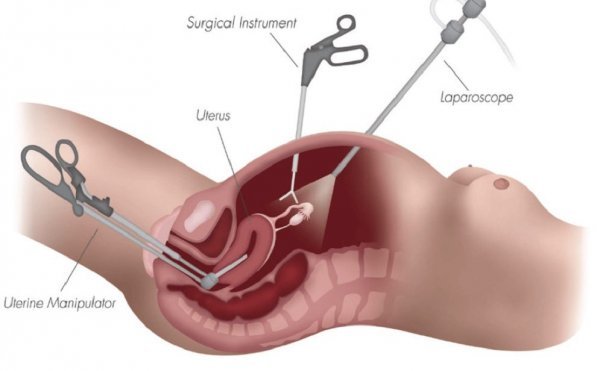 لاپاراسکوپی رحم بیهوشی دارد؟