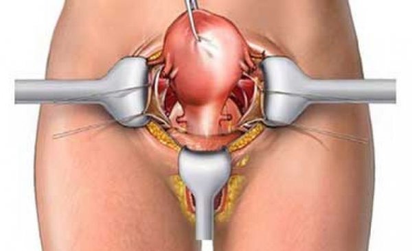  لاپاراسکوپی رحم بیهوشی دارد؟