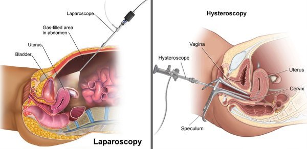  لاپاراسکوپی رحم بیهوشی دارد؟
