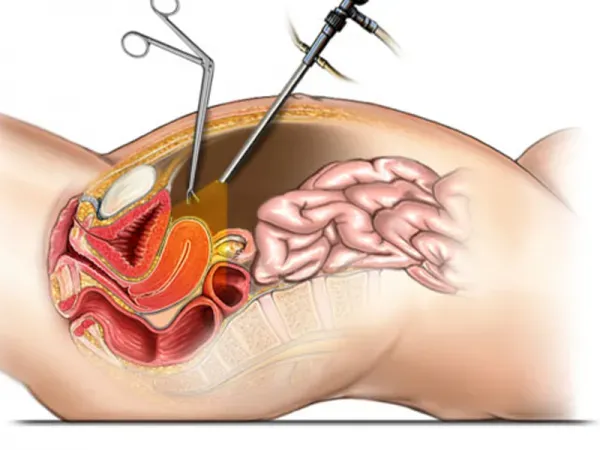  لاپاراسکوپی رحم بیهوشی دارد؟