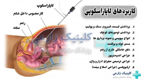  لاپاراسکوپی یا لاپاروسکوپی چیست و چگونه انجام می شود؟