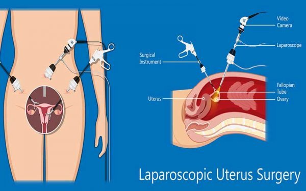 لاپاراسکوپی یا لاپاروسکوپی چیست و چگونه انجام می شود؟