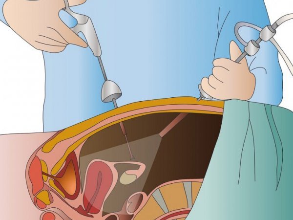  لاپاراسکوپی یا لاپاروسکوپی چیست و چگونه انجام می شود؟