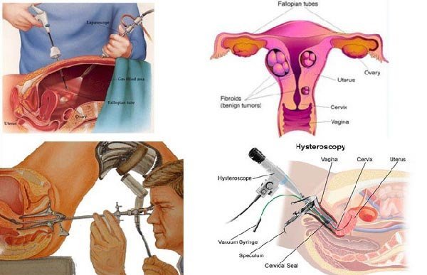  لاپاراسکوپی یا لاپاروسکوپی چیست و چگونه انجام می شود؟