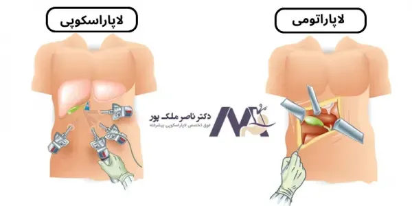  لاپاراسکوپی یا لاپاروسکوپی چیست و چگونه انجام می شود؟
