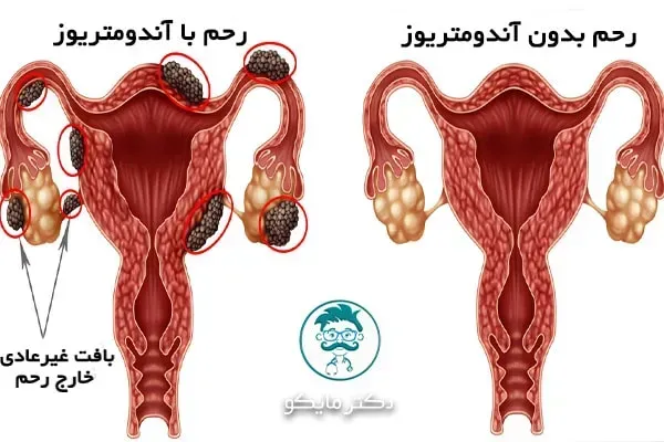 رابطه جنسی سکس زیاد چه تاثیری بر رحم و تخمدان دارد؟