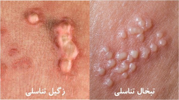  شکل ظاهری تبخال تناسلی در مردان / فرق زگیل و تبخال تناسلی در مردان
