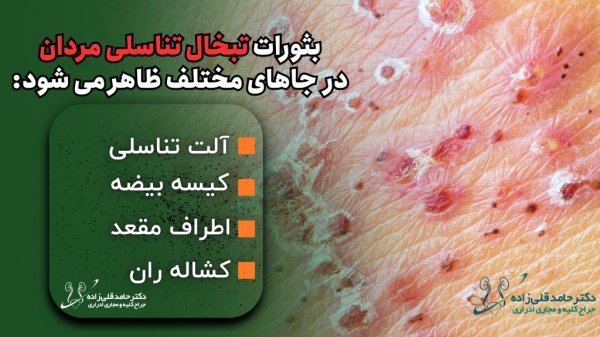  شکل ظاهری تبخال تناسلی در مردان / فرق زگیل و تبخال تناسلی در مردان