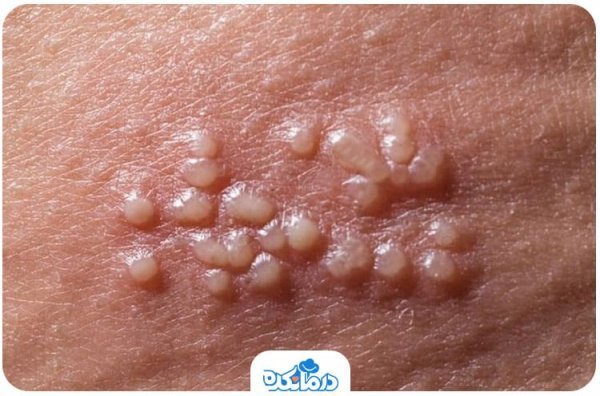  شکل ظاهری تبخال تناسلی در مردان / فرق زگیل و تبخال تناسلی در مردان