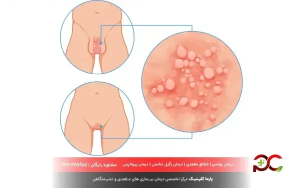  شکل ظاهری تبخال تناسلی در زنان / تفاوت تبخال تناسلی با زگیل تناسلی در زنان