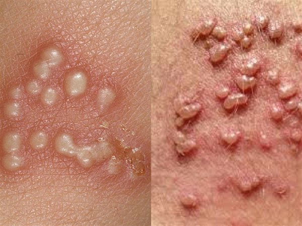  آیا تبخال تناسلی از طریق استخر منتقل می شود/ انتقال تبخال تناسلی از زن به مرد