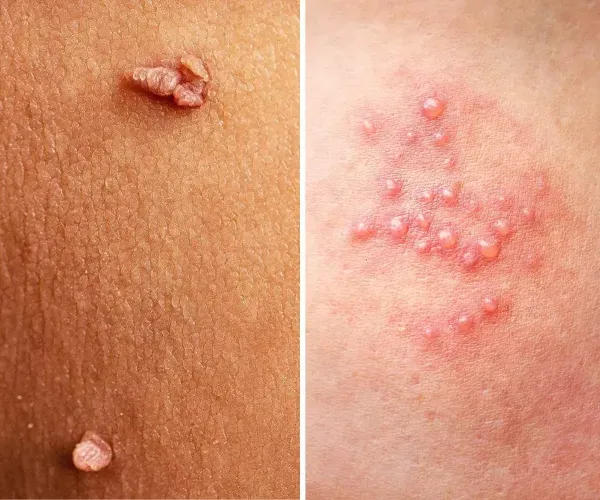  آیا تبخال تناسلی از طریق استخر منتقل می شود/ انتقال تبخال تناسلی از زن به مرد