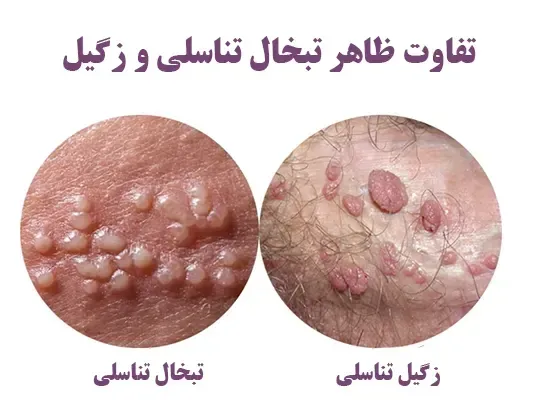  آیا تبخال تناسلی واکسن دارد / بهترین دارو برای تبخال تناسلی