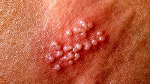  آیا تبخال تناسلی واکسن دارد / بهترین دارو برای تبخال تناسلی