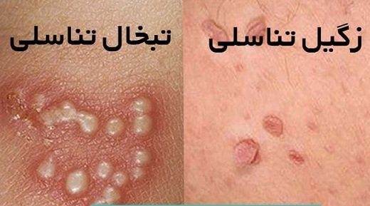  آیا تبخال تناسلی واکسن دارد / بهترین دارو برای تبخال تناسلی