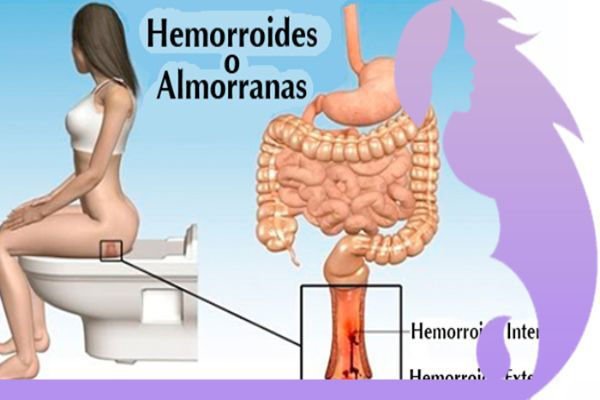عکس بواسیر بعد از زایمان طبیعی