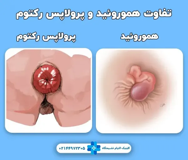  عکس بواسیر بعد از زایمان طبیعی