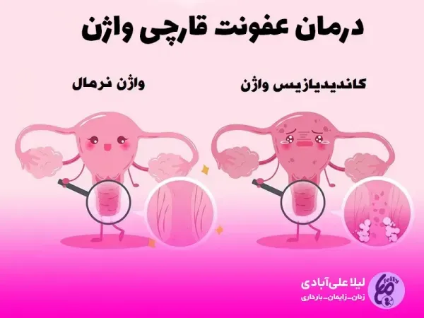  بهترین و قوی ترین قرص برای عفونت واژن