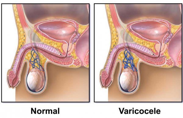 عوارض واریکوسل بیضه چپ / بیضه راست