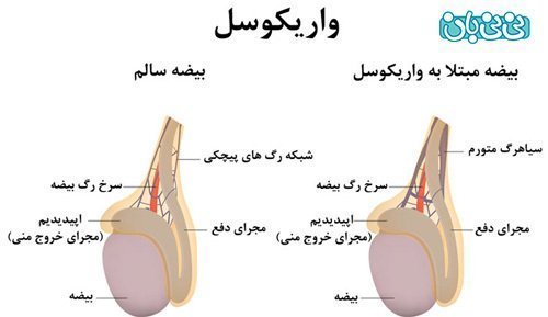  عوارض واریکوسل بیضه چپ / بیضه راست