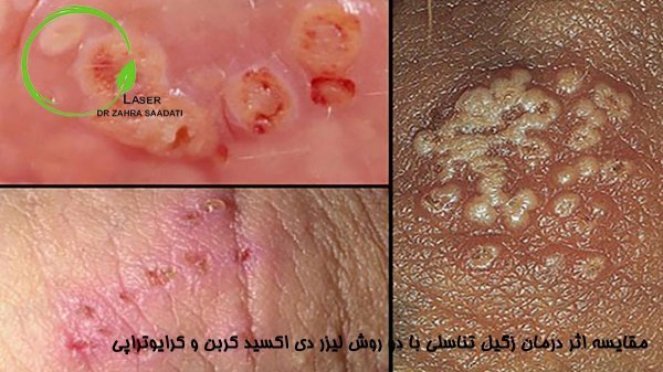  آیا بعد از لیزر + فریز زگیل تناسلی میتوان رابطه جنسی داشت؟