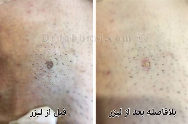  آیا بعد از لیزر + فریز زگیل تناسلی میتوان رابطه جنسی داشت؟