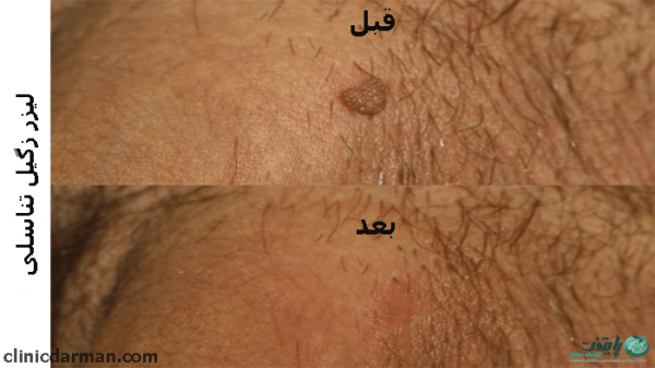  آیا بعد از لیزر + فریز زگیل تناسلی میتوان رابطه جنسی داشت؟