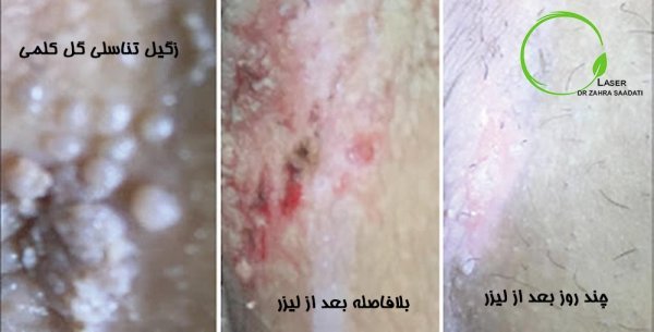  آیا بعد از لیزر + فریز زگیل تناسلی میتوان رابطه جنسی داشت؟