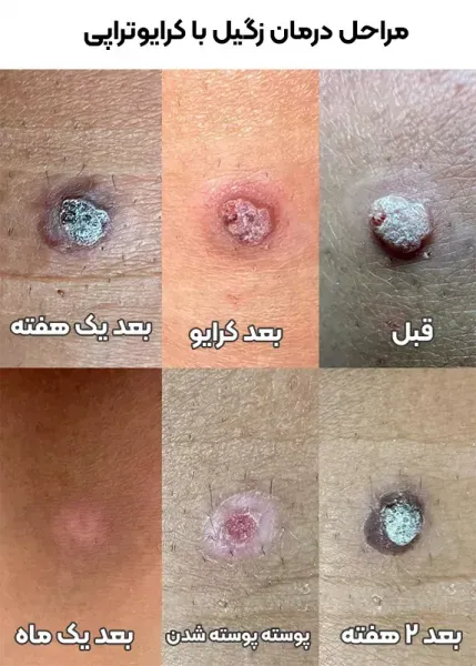  آیا بعد از لیزر + فریز زگیل تناسلی میتوان رابطه جنسی داشت؟