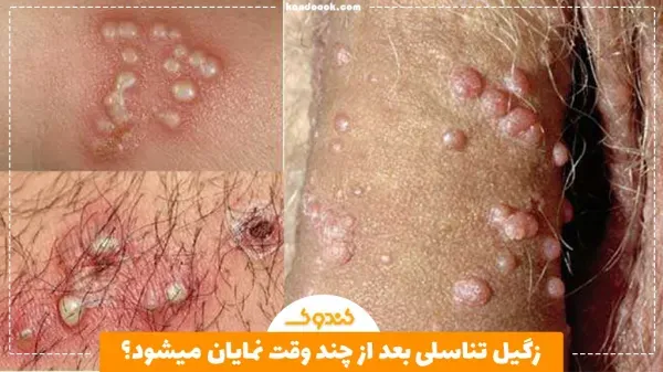 زگیل تناسلی چقدر بعد از رابطه جنسی / سکس نمایان میشود؟