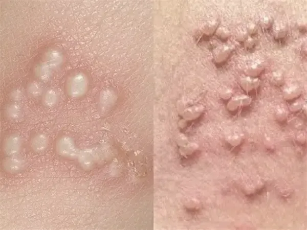  زگیل تناسلی چقدر بعد از رابطه جنسی / سکس نمایان میشود؟