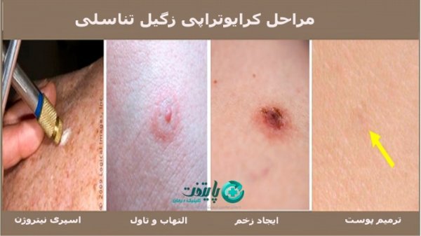  زگیل تناسلی چقدر بعد از رابطه جنسی / سکس نمایان میشود؟