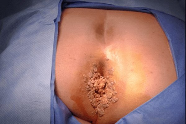  زگیل تناسلی چقدر بعد از رابطه جنسی / سکس نمایان میشود؟