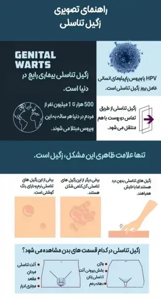  آیا زگیل تناسلی در کودکان خطرناک است +عکس زگیل تناسلی کودکان