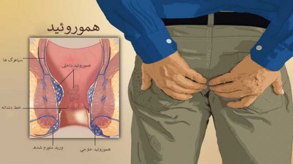 چه زمانی بواسیر نیاز به جراحی / عمل دارد؟