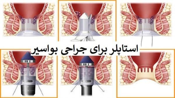  چه زمانی بواسیر نیاز به جراحی / عمل دارد؟