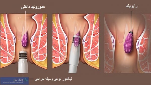  چه زمانی بواسیر نیاز به جراحی / عمل دارد؟