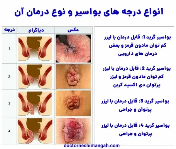  چه زمانی بواسیر نیاز به جراحی / عمل دارد؟