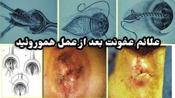  چه زمانی بواسیر نیاز به جراحی / عمل دارد؟