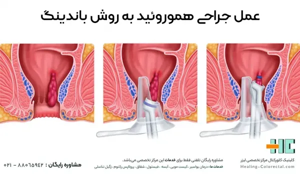  چه زمانی بواسیر نیاز به جراحی / عمل دارد؟