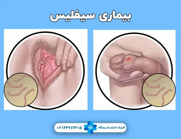 عکس بیماری سفلیس در زنان+بهترین دارو برای درمان سفلیس