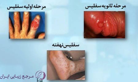  عکس بیماری سفلیس در زنان+بهترین دارو برای درمان سفلیس
