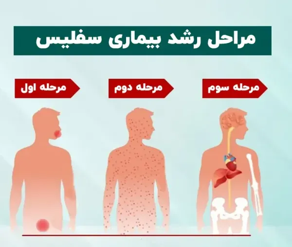  عکس بیماری سفلیس در زنان+بهترین دارو برای درمان سفلیس