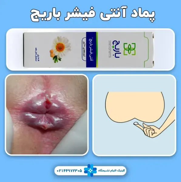  بهترین پماد برای درمان شقاق در بارداری